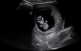 Ultrasound scan of 11 week fetus.