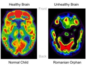 brainSlide300x230 Side by side graphic of brain scans. Left is Healthy brain of a normal child with most parts of the brain brightly colored. The Right image is an unhealthy brain of a Romanian orphan. More than half of the brain is dark with no hightlights.